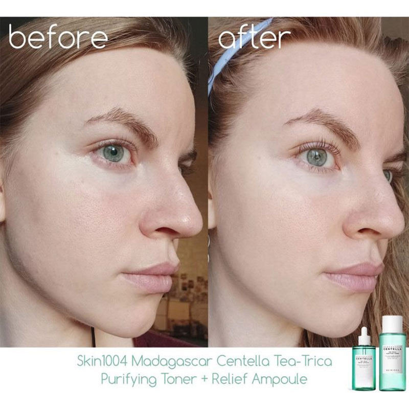 تونر ضد جوش تی تریکا اسکین 1004 SKIN سنتلا Centella مدل Tea-Trica Purifying Toner حجم 210ml