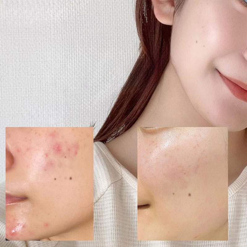 آمپول تسکین دهنده و مرطوب کننده آنوا Anua حاوی عصاره هوتونیا کوردتا مدل Heartleaf 80% حجم 30ml