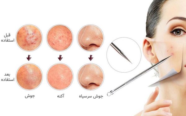 میله پیلینگ صورت - Image 3