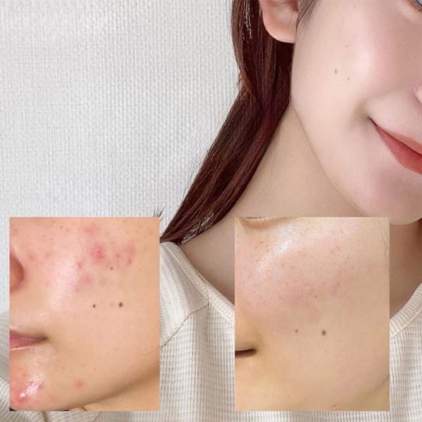 آمپول تسکین دهنده و مرطوب کننده آنوا Anua حاوی عصاره هوتونیا کوردتا مدل Heartleaf 80% حجم 30ml - Image 2